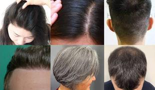 Najnovejša metoda, ki obljublja popolno obnovitev las