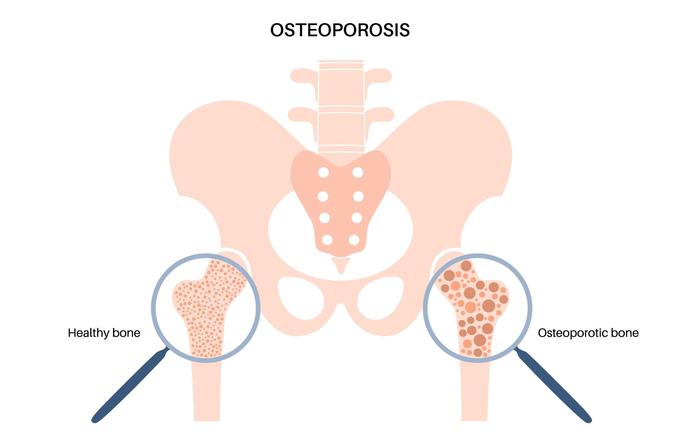 Osteoporoza2 | Foto: Medicofit