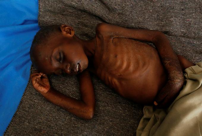 Akutno podhranjen in brezdomen štirileten deček Dieudonne Sabwa, ki čaka na zdravniško pomoč v bolnišnici v provinci Kasai.  | Foto: Reuters