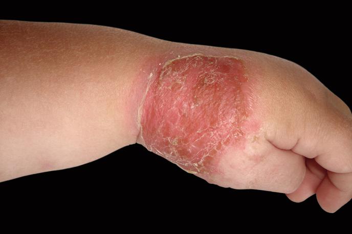 Impetigo | Bolezen je najpogostejša pri otrocih, saj so ti pogosteje v stiku z različnimi površinami, se pogosteje praskajo in imajo nekoliko slabšo osebno higieno. | Foto Profimedia
