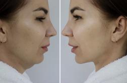 Čudežni dvig obraza? Kaj morate vedeti o posegu, ki je tudi pri nas velik hit.