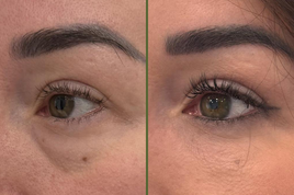 Kako lahko napačen lepotni poseg poslabša videz?