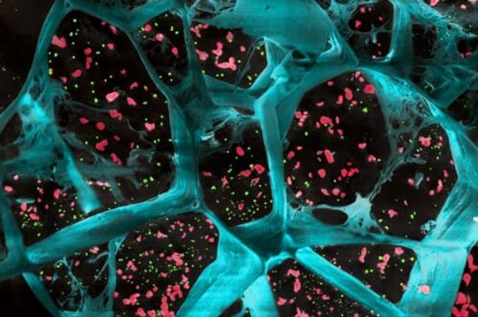 gel, rak | Mikroskopska slika hidrogela (modra barva) z učinkovinama (rdeča in zelena) za preprečevanje (ali vsaj bistveno upočasnjevanje) ponovnega razvoja rakastih celic | Foto University of Wisconsin–Madison