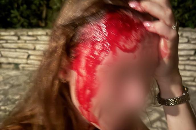 Poškodbe dekleta, ki so jo pretepli varnostniki na plaži pred hotelom Kempinski Adriatic v Savudriji | Poškodba dekleta, ki je bila žrtev brutalnega napada varnostnikov hotela Kempinski Adriatic v Savudriji. | Foto Osebni arhiv