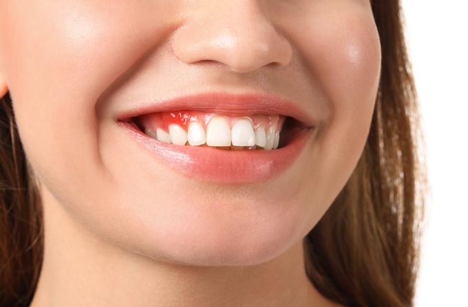 Parodontoza je ena najpogostejših bolezni ustne votline. | Foto: Shutterstock