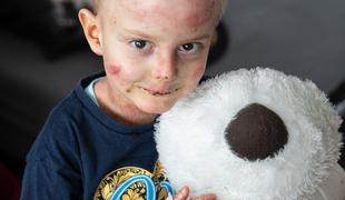 Deček Miloš z redko boleznijo kože v ZDA prejel prvi odmerek zdravila