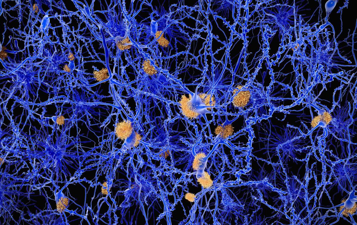 nevroni, Alzheimerjeva bolezen | Čim zgodnejše odkrivanje Alzheimerjeve bolezni že med primarno zdravstveno oskrbo bi močno povečalo obete za uspešno obvladovanje te krute in zahrbtne bolezni. | Foto RMIT