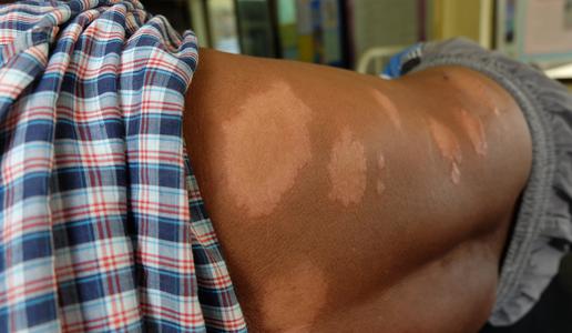 Na Hrvaškem po več desetletjih potrdili primer gobavosti