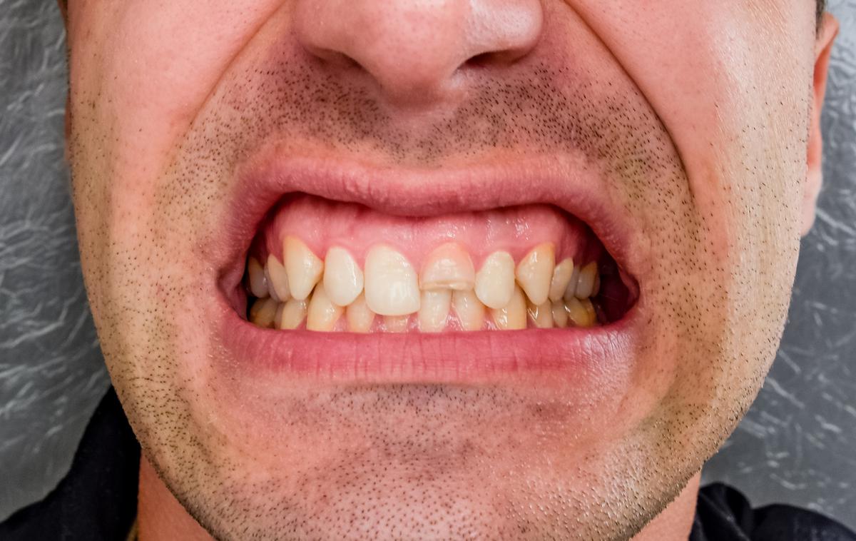 dlesni | Raziskava znanstvenikov univerze Illinois v Chicagu je pokazala, da je ista bakterija, ki povzroča bolezni dlesni, lahko tudi poglavitni patogeni vzrok Alzheimerjeve bolezni.  | Foto Getty Images