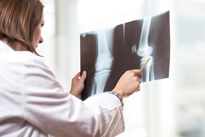 zdravnik rentgen koleno | Foto: Shutterstock