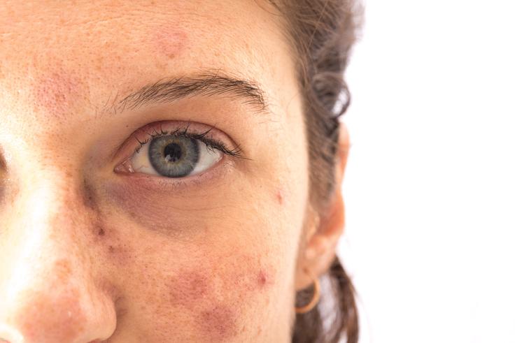 pigmentni madeži, sončne pege | Foto: Shutterstock