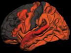 možgani, Alzheimerjeva bolezen