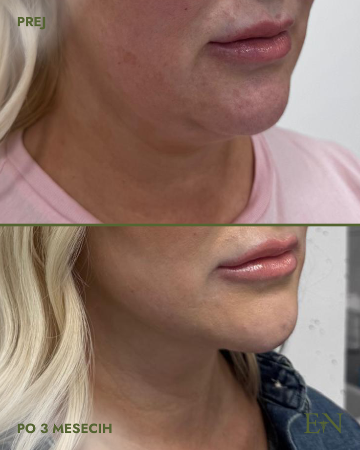 Rezultat minimalno invazivnega posega NeckDefine Pro+: manj podbradka, bolj definirana čeljust in bolj napeta koža vratu. | Foto: Dr. Ernest Novak