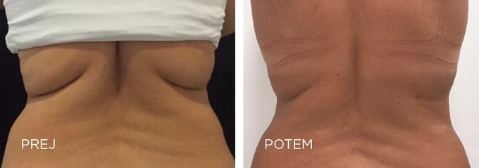 CoolSculpting poseg | Foto: 