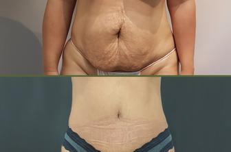 Kakšna bi morala biti realna pričakovanja po operaciji trebuha?