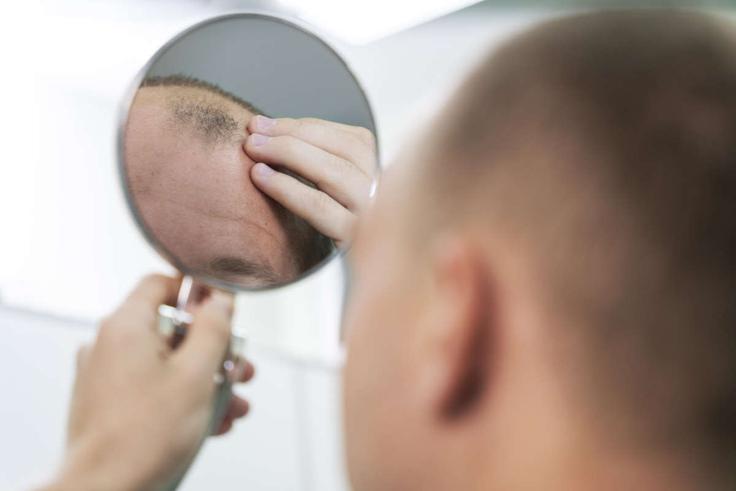 Moška plešavost (androgena alopecija) prizadene več kot 50 % moških do 50. leta, vendar jo lahko doživijo tudi ženske in se pojavi kot razpršeno redčenje las, glavni krivec pa so najpogosteje hormonske spremembe oz. hormon DHT (dihidrotestosteron). | Foto: Freepik.com / Mind trade d.o.o.