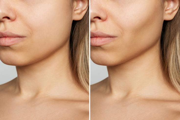 buccal fat removal | Foto: Shutterstock