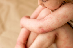 Bolečina, sram in izčrpanost: resničnost bolnikov z atopijskim dermatitisom
