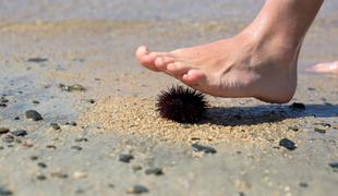 Kaj storiti, ko stopite na morskega ježka ali vas ožge meduza? #video