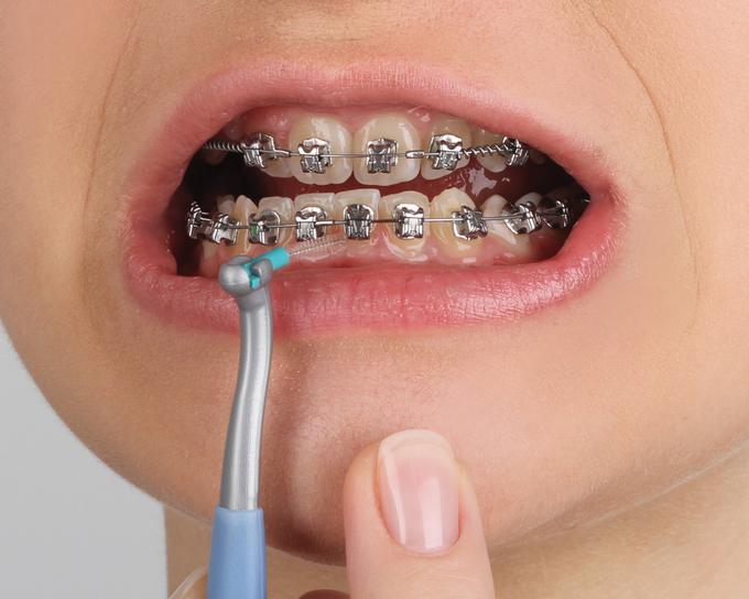Tudi v ustih s fiksnim ortodontskim aparatom je treba očistiti medzobne prostore. Izberemo ustrezno velike medzobne ščetke, ki imajo goste in mehke ščetine. Večje medzobne ščetke lahko uporabimo za ščetkanje pod žičko, ob nosilcih aparata.  | Foto: Curaprox