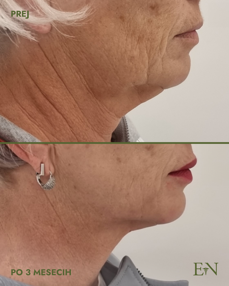 NeckDefine Pro+ zapolnjuje “vmesni prostor” med neinvazivnimi tretmaji in kirurškimi posegi. | Foto: Dr. Ernest Novak