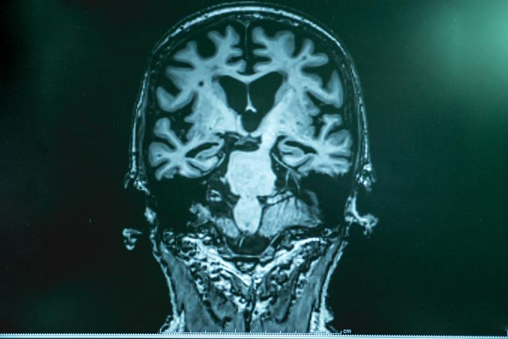 Alzheimerjeva bolezen trenutno ni ozdravljiva. Obstajajo zdravila, ki lahko začasno ublažijo simptome in nekoliko upočasnijo napredovanje bolezni, vendar ne zaustavijo njenega razvoja. Raziskave novih terapij sicer potekajo, a zdravila, ki bi bolezen popolnoma ozdravilo, še ni. | Foto: Shutterstock