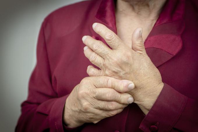 Revmatoidni artriris rok in prstov | Foto: Medicofit
