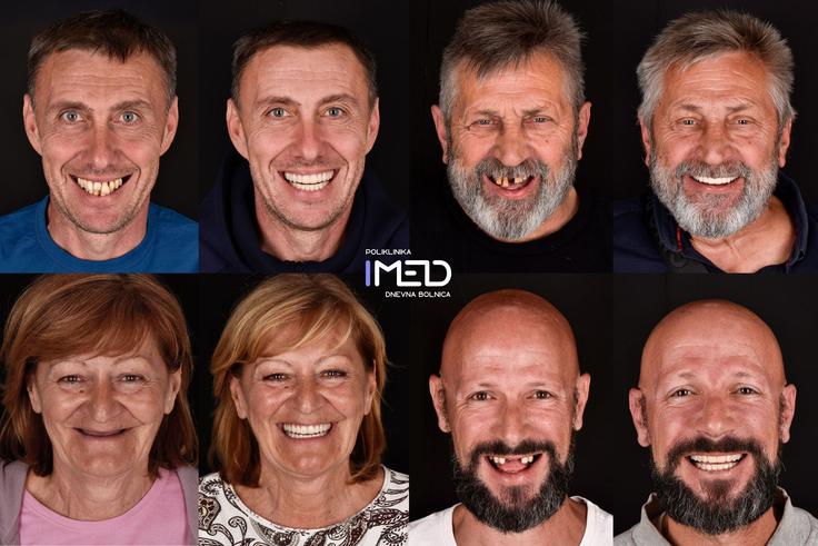 Primeri pacientov pred implantološko terapijo in po njej | Foto: IMED