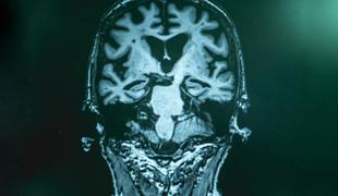Novo upanje za bolnike z Alzheimerjevo boleznijo?