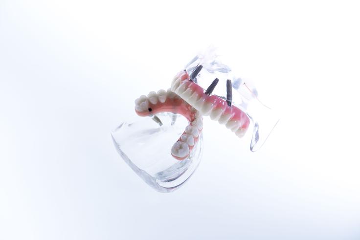 Prikaz implantološke rešitve ALL-ON-4, kjer je celoten zobni lok stabilno pritrjen na štiri strateško nameščene implantate. Takšna razporeditev omogoča izjemno stabilnost, naraven videz in polno funkcionalnost zob.  | Foto: ORTOIMPLANT DENTAL SPA
