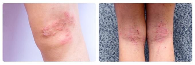 Kožni dermatitis kot posledica krčnih žil | Foto: 