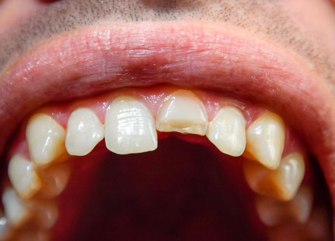 Med raziskavo so odkrili močno povezavo med periodontitisom, to je močnejše oziroma obsežnejše vnetje dlesni, in možganskimi okvarami. | Foto: Getty Images