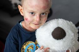 Deček Miloš z redko boleznijo kože v ZDA prejel prvi odmerek zdravila