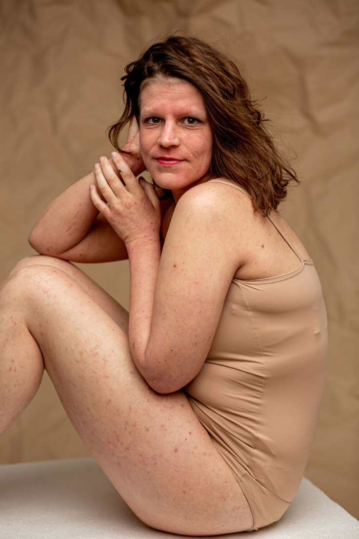 Atopijski dermatitis | Foto: INES IMAGES