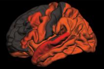 možgani, Alzheimerjeva bolezen
