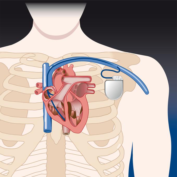 Srčni spodbujevalnik se vgradi v primeru, kadar prihaja do motenj nastajanja ali prevajanja električnega impulza v srcu, zaradi česar začne srce utripati počasi.  | Foto: 
