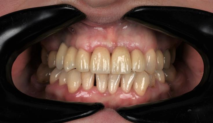 Primer oskrbe parodontalno prizadetega pacienta. | Foto: Dental Solman