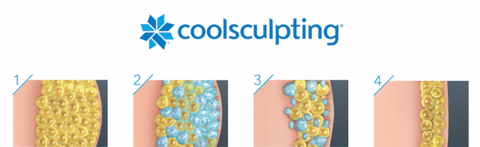 CoolSculpting poseg | Foto: 