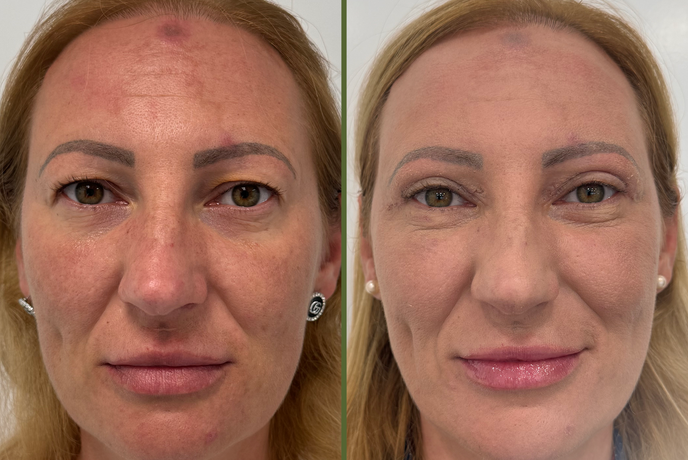 Razmišljate o operaciji vek? Teh stvari vam pogosto nihče ne pove.