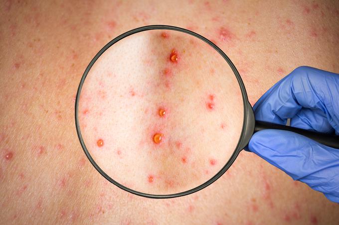 V Komendi so v manj kot tednu dni potrdili dva primera okužbe z ošpicami. | Foto: Getty Images