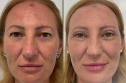 Razmišljate o operaciji vek? Teh stvari vam pogosto nihče ne pove.