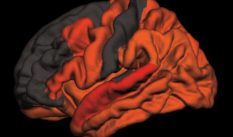 Odkrili povezavo med pomanjkanjem kakovostnega spanca in Alzheimerjevo boleznijo
