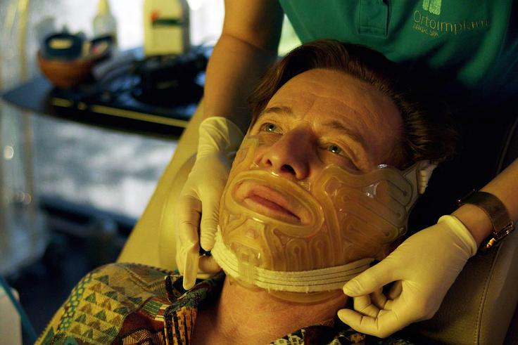 All-on-4 je sistem, s katerim se v zgornjo ali spodnjo brezzobo čeljust vstavijo štirje vsadki, ki podpirajo fiksno protezo. | Foto: ORTOIMPLANT DENTAL SPA