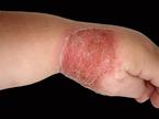 Impetigo