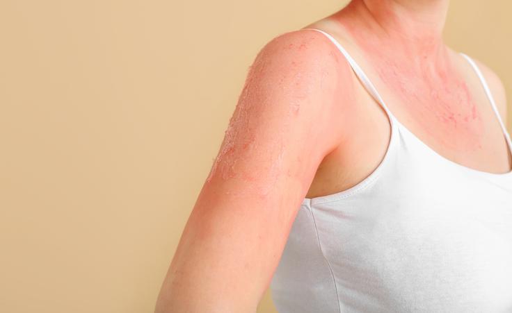 alergija na sonce | Foto: Shutterstock