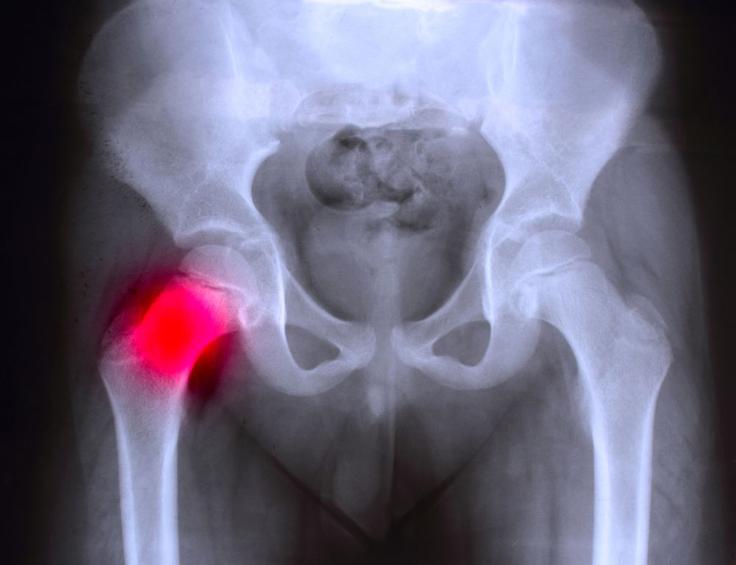 sindrom-kolka-diagnoza | Foto: Medicofit