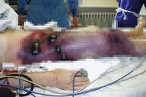 Bolezen plinska gangrena