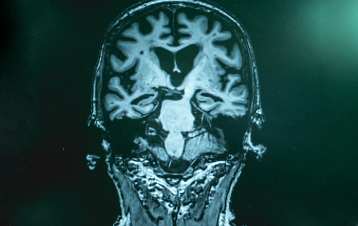 Možgani, Alzheimerjeva bolezen | Foto Shutterstock