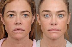 Denise Richards razkrila fotografije pred in po liftingu obraza