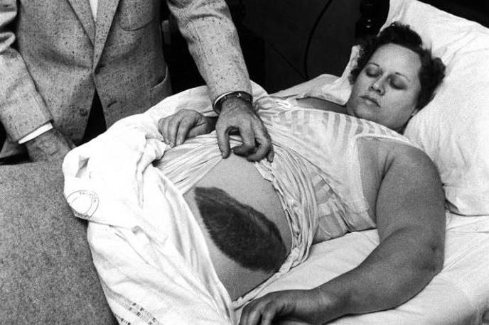 Ann Hodges | Ann Hodges 30. novembra 1954 med zdravniškim pregledom. Zaradi udarca meteorita je imela na boku veliko modrico.  | Foto Getty Images